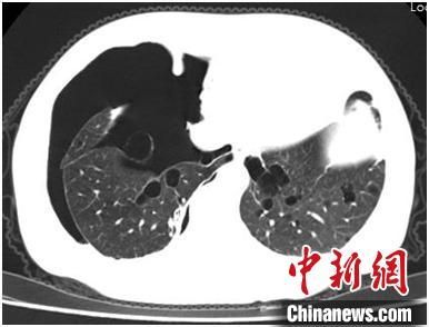 　　王大姐胸部CT顯示雙肺彌漫性囊性病變，右側(cè)氣胸�！〔軡� 攝